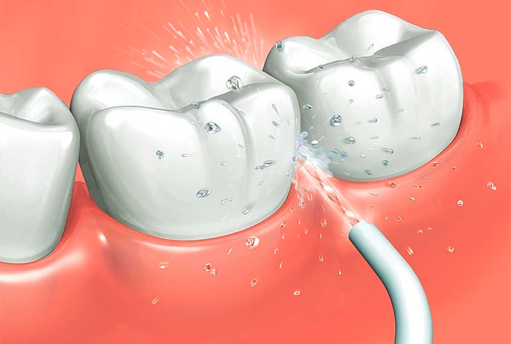 IRRIGADOR BUCAL ORAL 4 CABEZAS